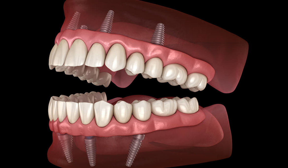 A New Dawn for Dentures: The Revolution of All-On-4 Dental Implants